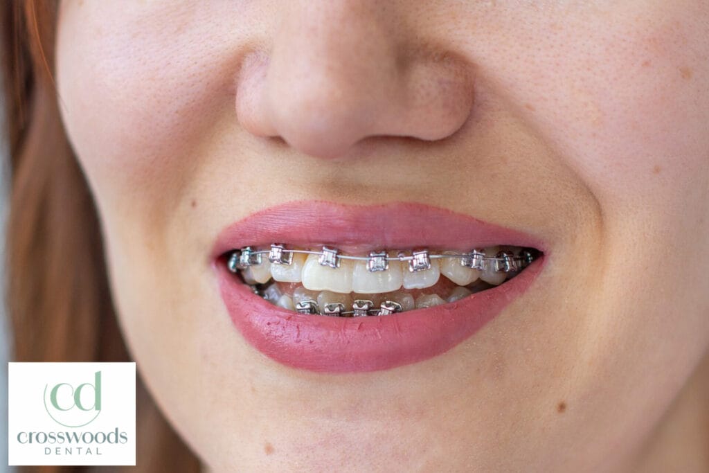 Clear aligner benefits